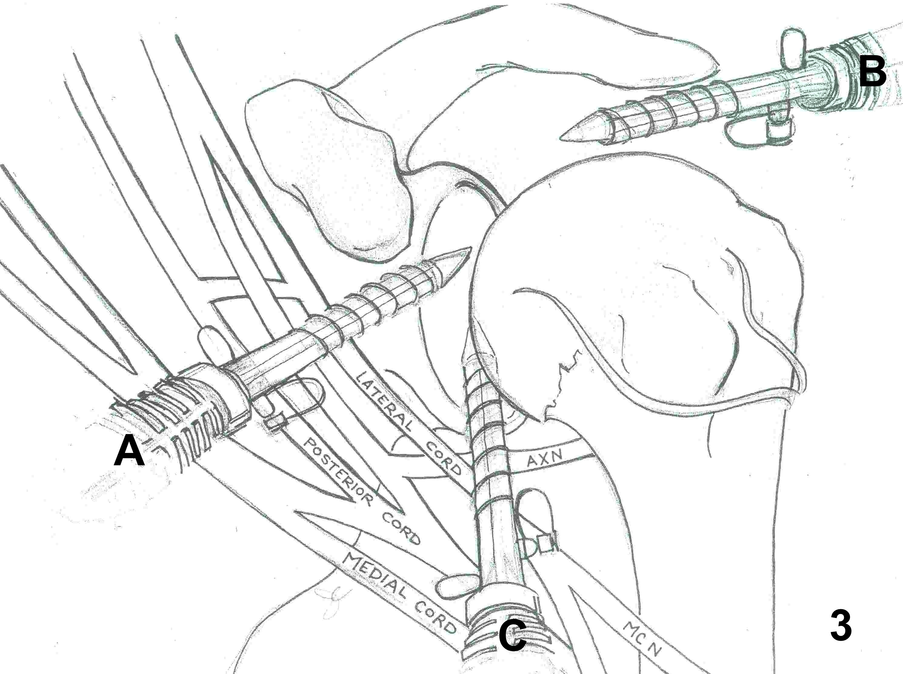 Shoulder Arthroscopy Portals